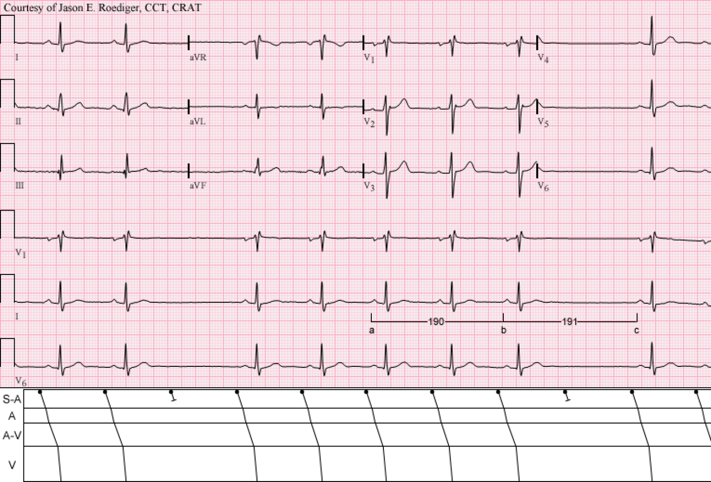 jason-s-blog-ecg-challenge-of-the-week-for-august-5-12-what-s-the